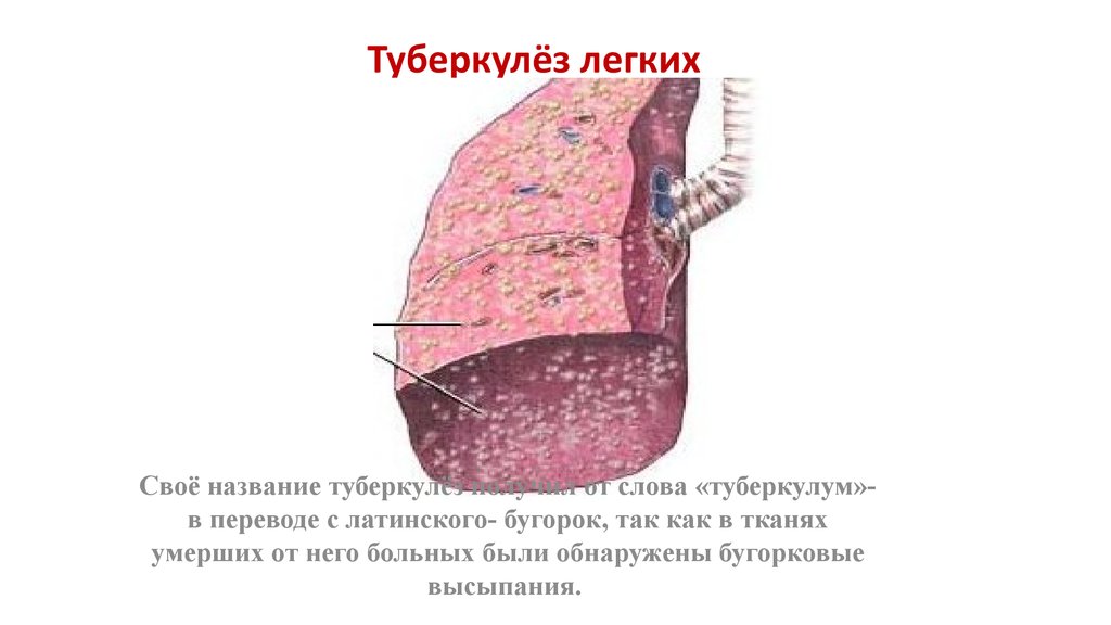 Туберкулёз легких