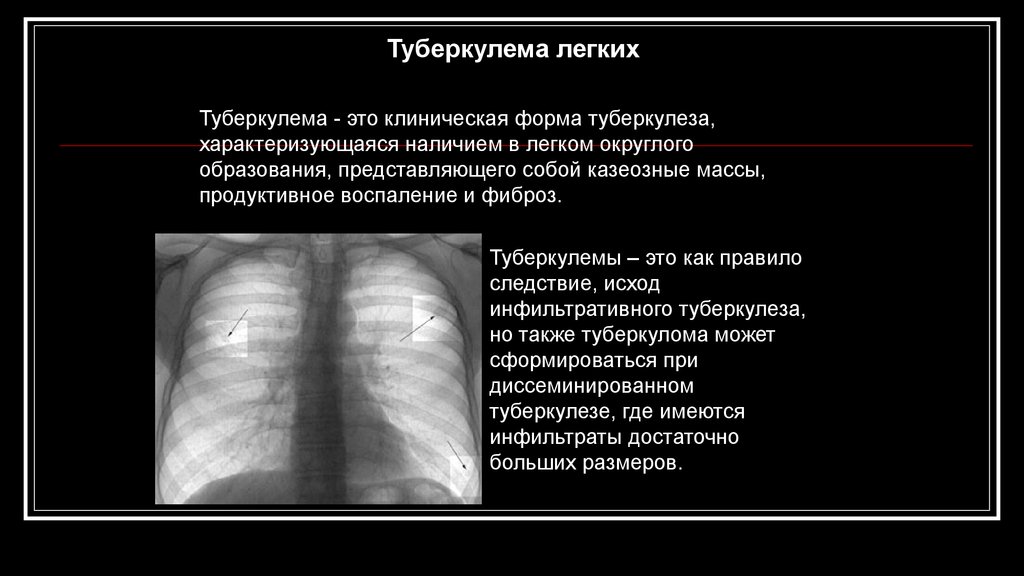 Клинический случай туберкулез. Рентген туберкулез туберкулема. Туберкулема легких рентген. Рентген признаки туберкулемы. Туберкулемы на рентгене.