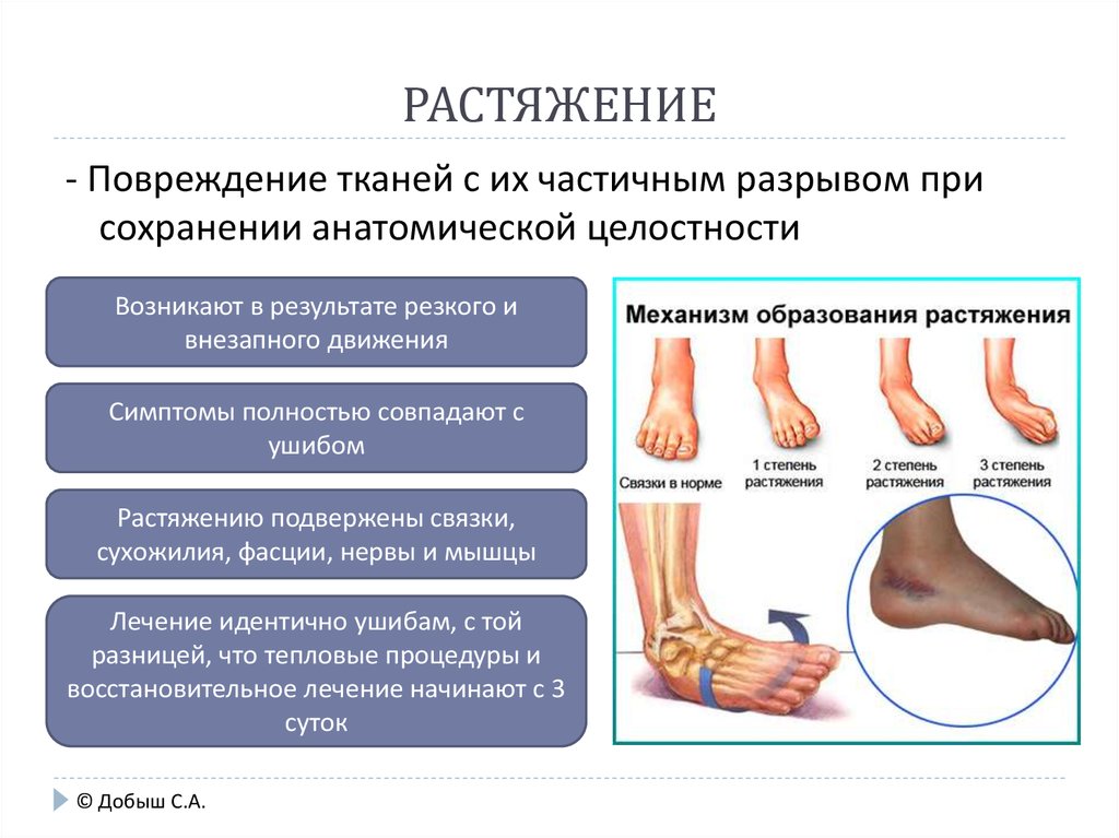 Растяжение стопы. Надрыв связок голеностопного сустава гематома. Растяжение связок голеностопа клиника. Растяжение, вывих голеностопа симптомы. Растяжение связок голеностопа мазь.