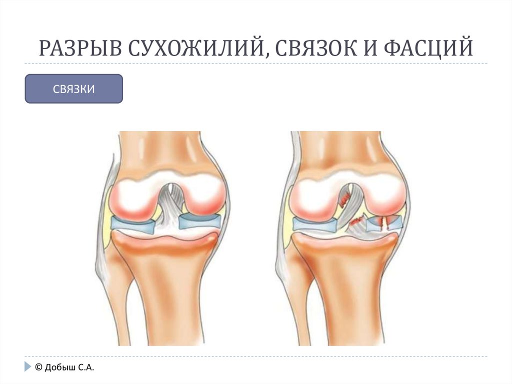 Растяжение колена. Крестообразные связки коленного сустава анатомия. Лигаментоз надколенника. Крестообразные связки колена анатомия. Лигаментоз связок коленного сустава.