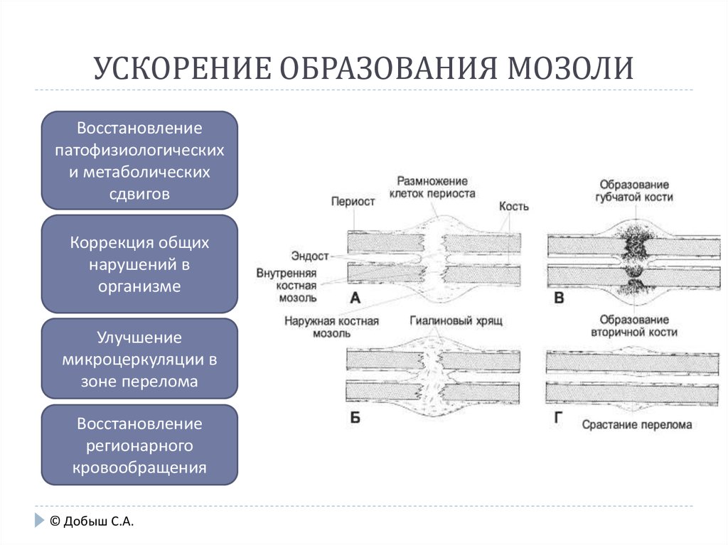 Ускорить обучение. Сроки образования костной мозоли. Образование костной мозоли ускоряет. Ускорения формирования костной мозоли. Стадии образования костной мозоли.