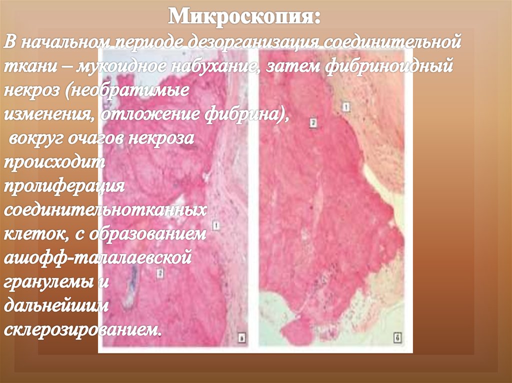 Гранулема Ашоффа гистология. Гранулема Ашофф-Талалаева. Синусы Рокитанского Ашоффа.