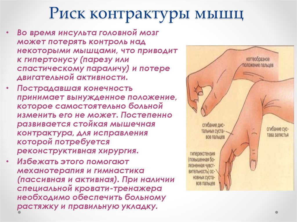 Заболевание мышц рук. Парциальная мышечная контрактура. Возникновение контрактуры.