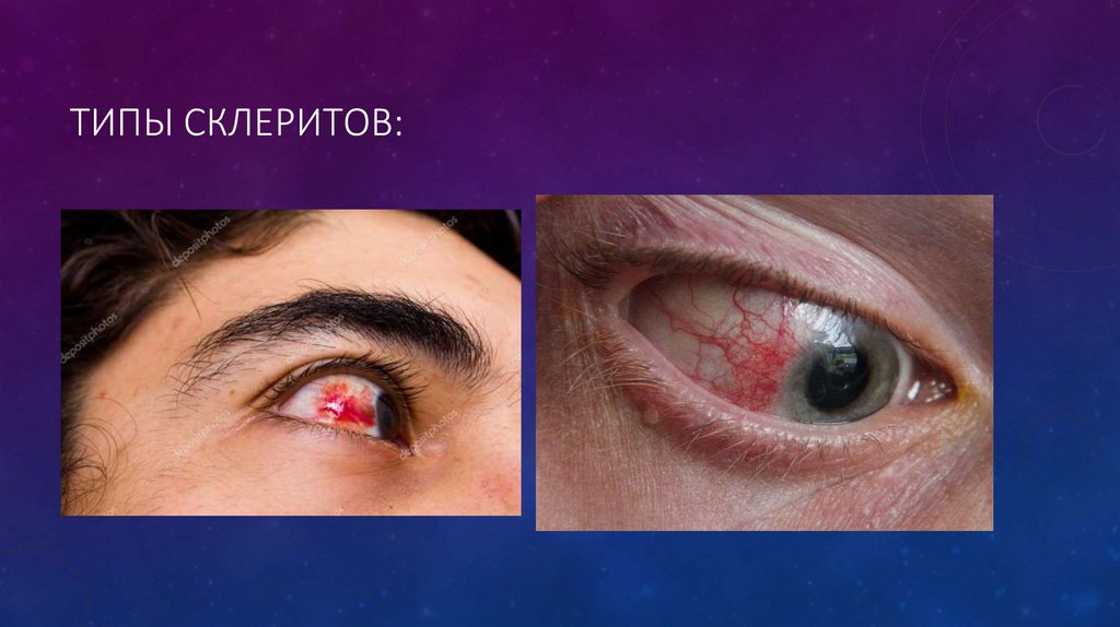 Склериты. Виды склеритов - презентация онлайн