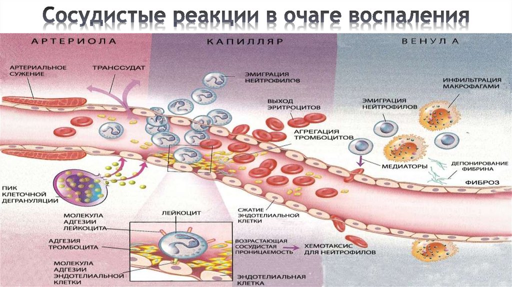 Патогенез воспаления схема