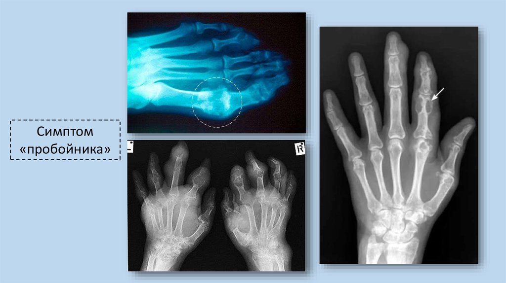 Подагра рентген. Подагрический артрит кистей рентген. Подагра рентген симптом пробойника.