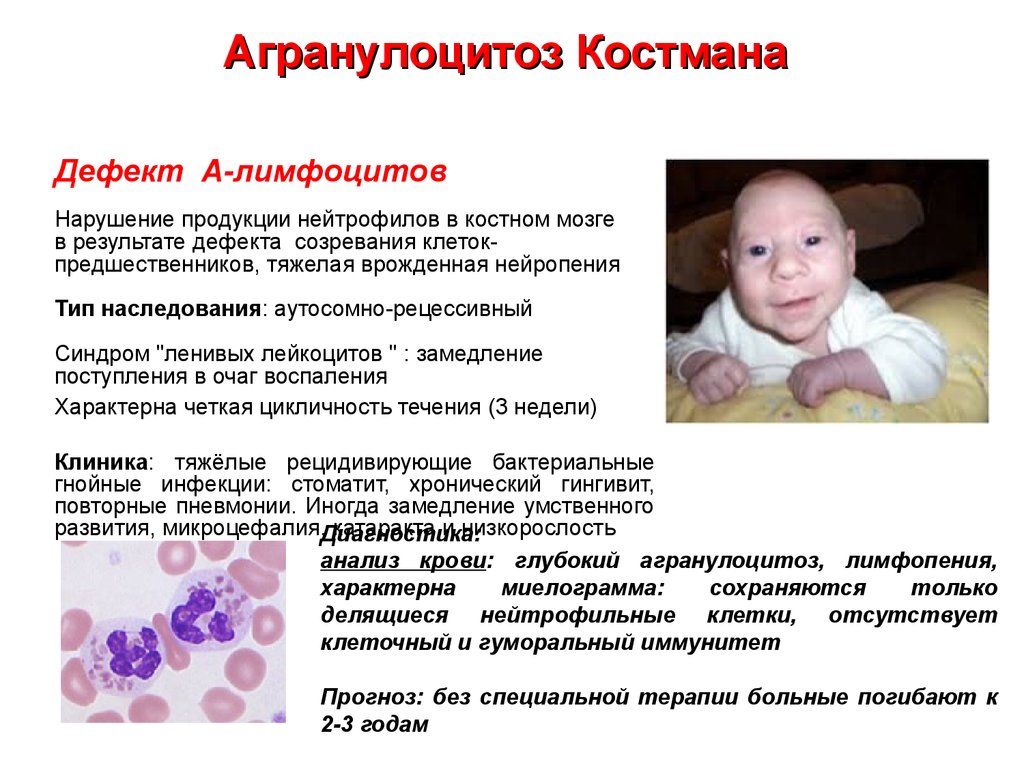 Синдром вялого ребенка. Агранулоцитоз причины развития. Агранулоцитоз механизм развития. Агранулоцитоз клинические проявления.