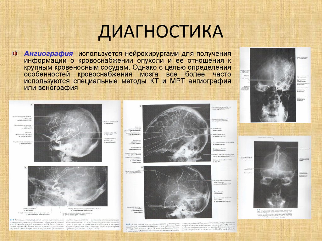 Диагностика 24. Опухоли головного мозга и спинного мозга у детей. Медуллобластома спинного мозга у детей. М24 диагноз. Кровоснабжение опухоли.