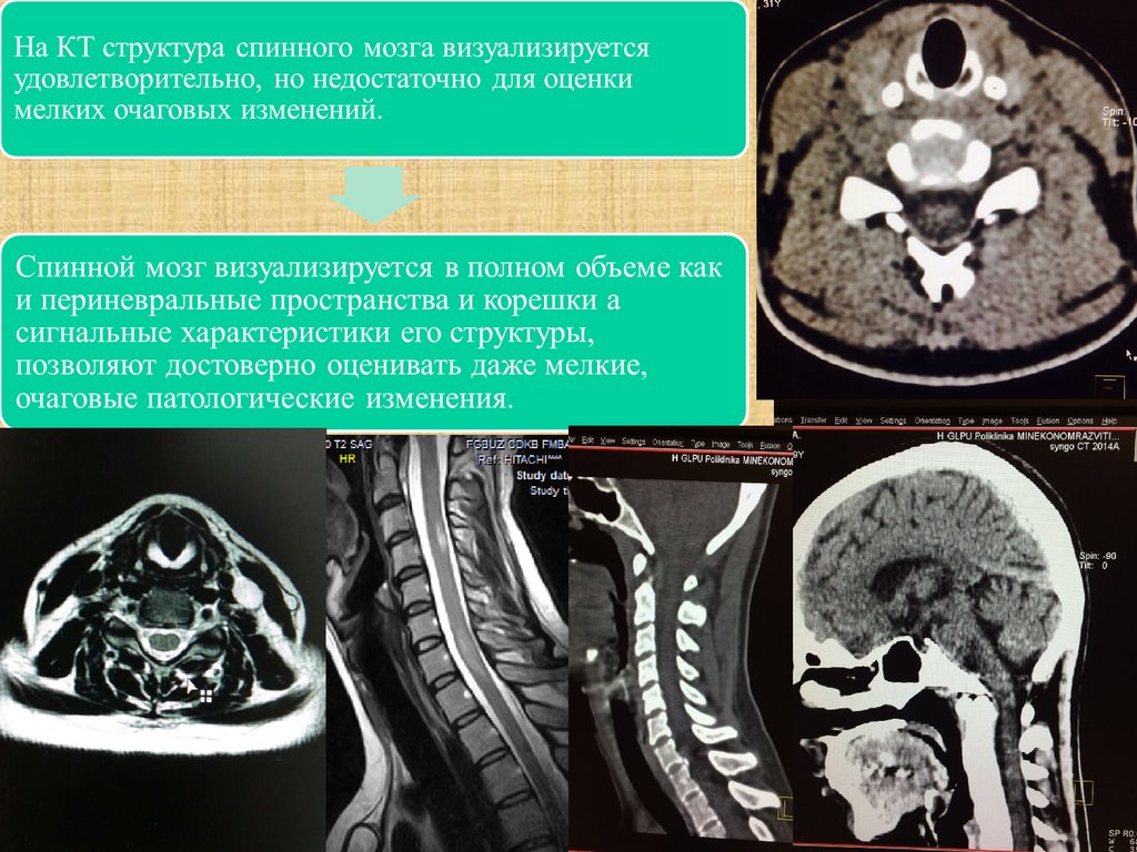 Опухоли головного и спинного мозга презентация