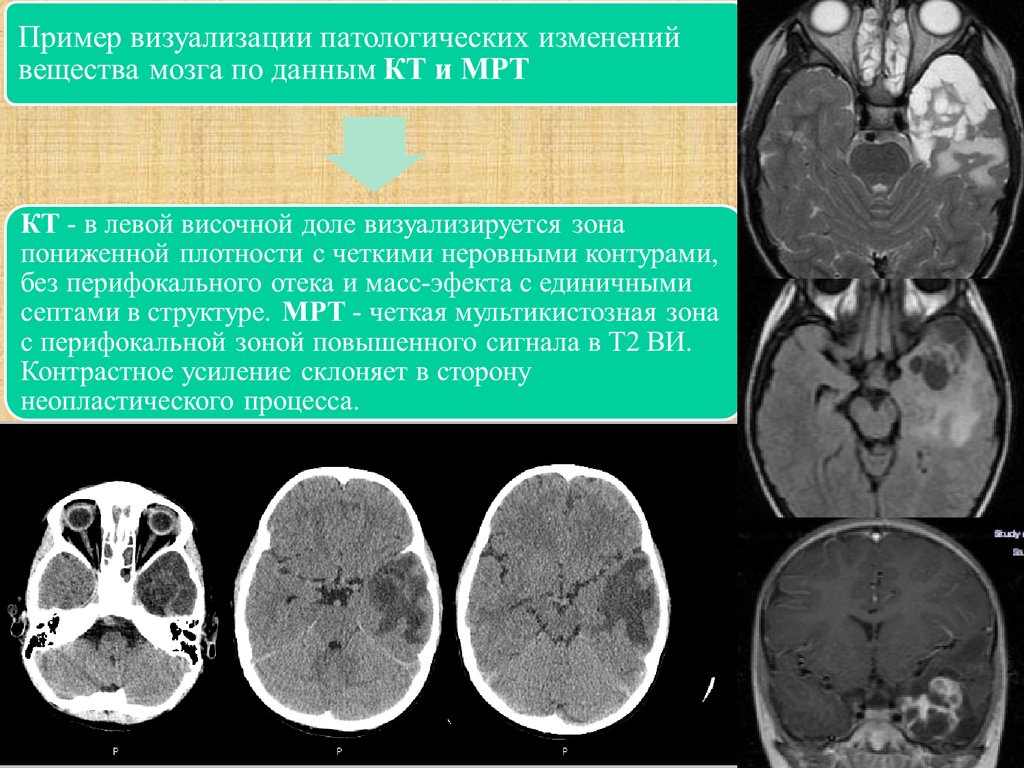 Опухоли головного и спинного мозга презентация