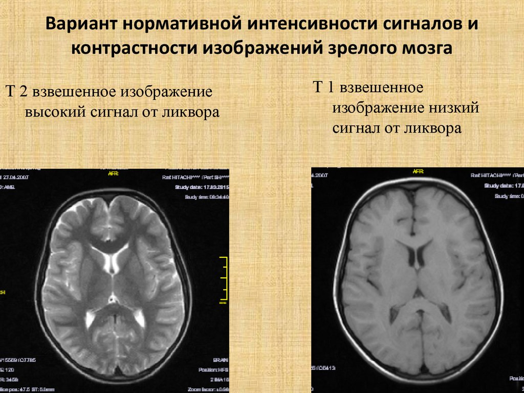 Т2 взвешенное изображение