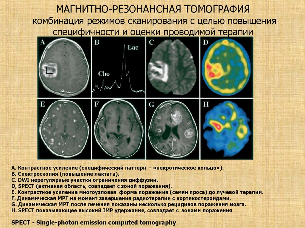Виды опухолей головного. Диагностические критерии глиомы головного мозга. Объемное образование головного мозга диагноз. Локализация опухолей головного мозга. Диагностические критерии опухоли головного мозга.