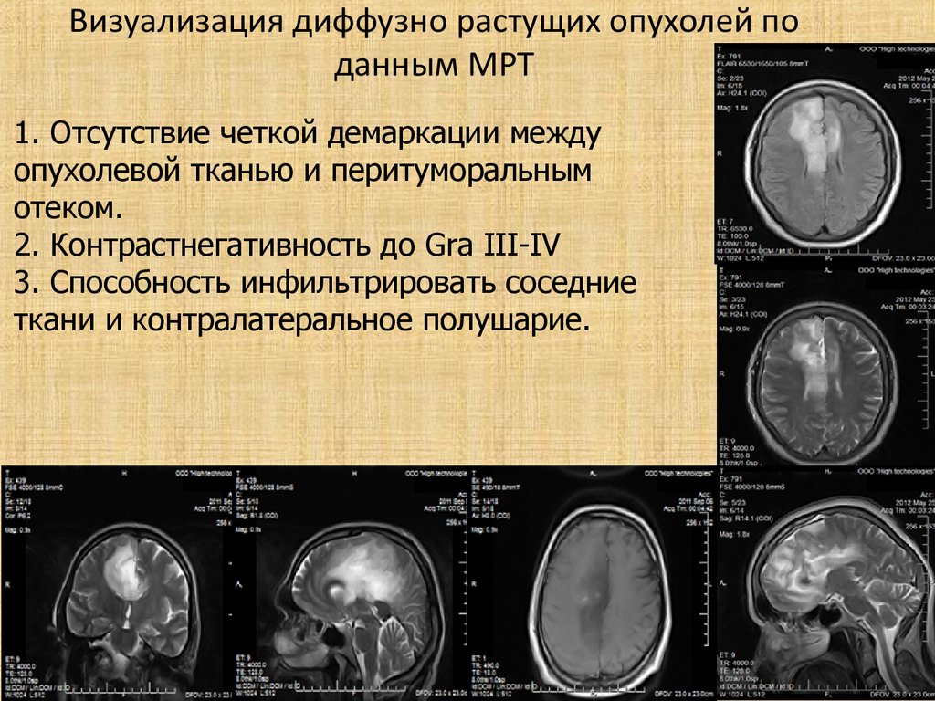 Объемное образование головного мозга код. Диффузного объемного образования головного мозга. Диффузная опухоль головного мозга. Диффузная опухоль головного мозга мрт.