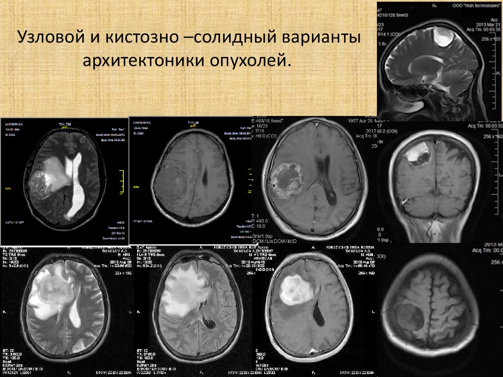 Солидное строение. Кистозно-Солидное образование в головном мозге. Кистозно-Солидное образование головного мозга мрт. Кистозно-Солидное образование головного мозга на кт. Кистозно-солидная опухоль головного мозга.