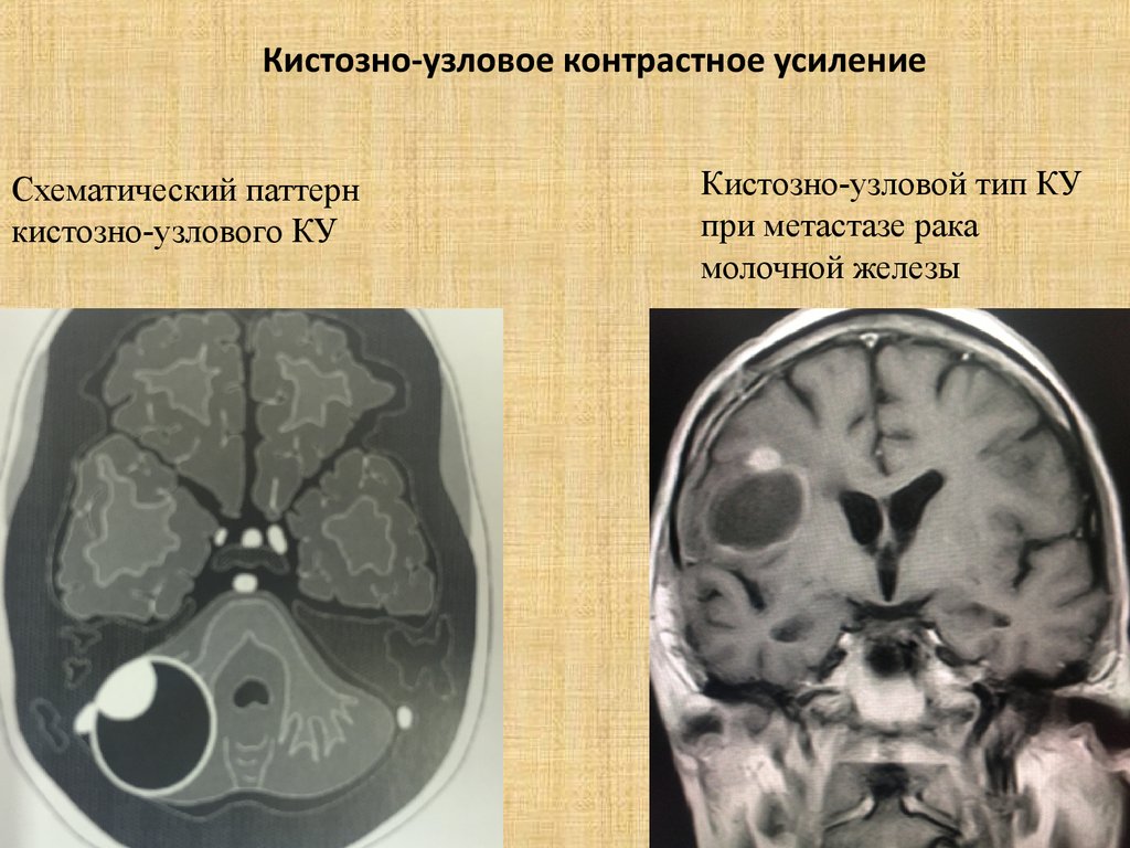 Контрастное усиление при компьютерной томографии мозга применяют в случаях если необходимо