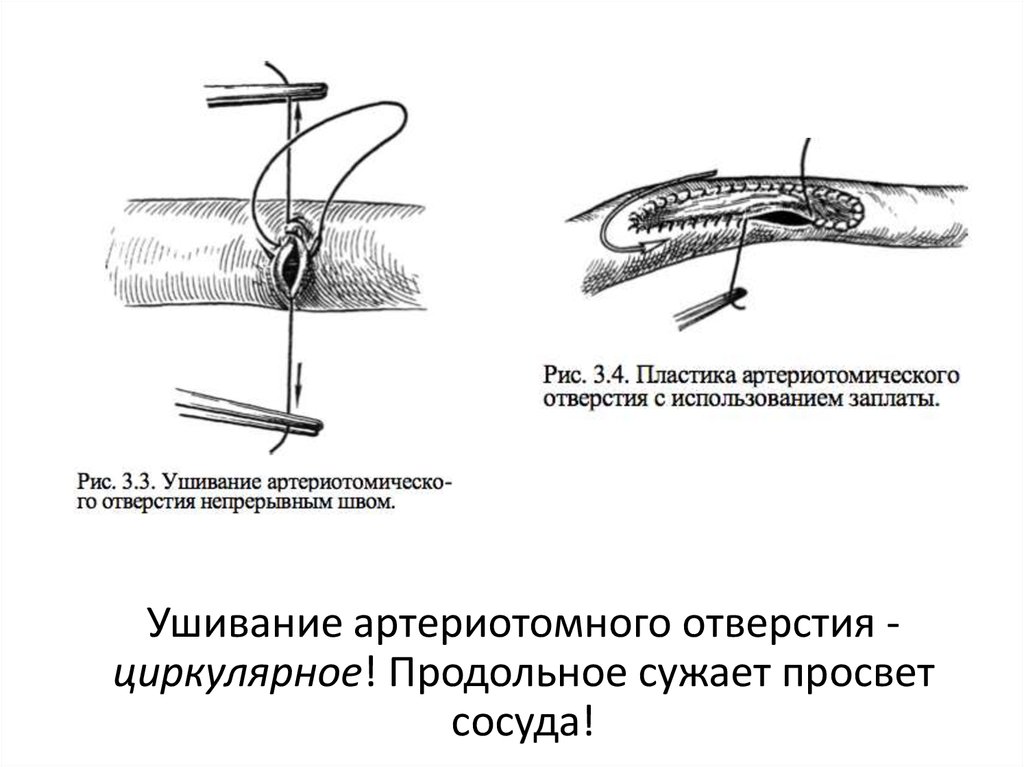 Сосудистый шов