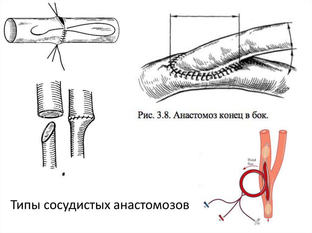 Сосудистый шов