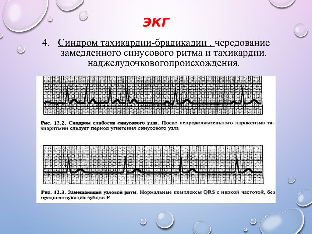 Синусовая тахикардия. Синдром слабости синусового узла ЭКГ. Слабости синусового узла синдром (СССУ): ЭКГ. Синдром синусового узла на ЭКГ. Тахи бради на ЭКГ.