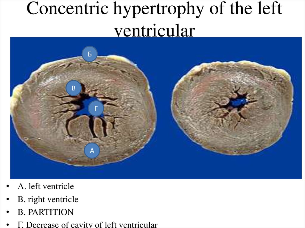 concentric-left-ventricular-remodeling-with-adequate-systolic-function