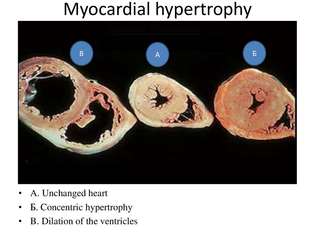 Myocardial infarction, pathological anatomy, complications, causes of