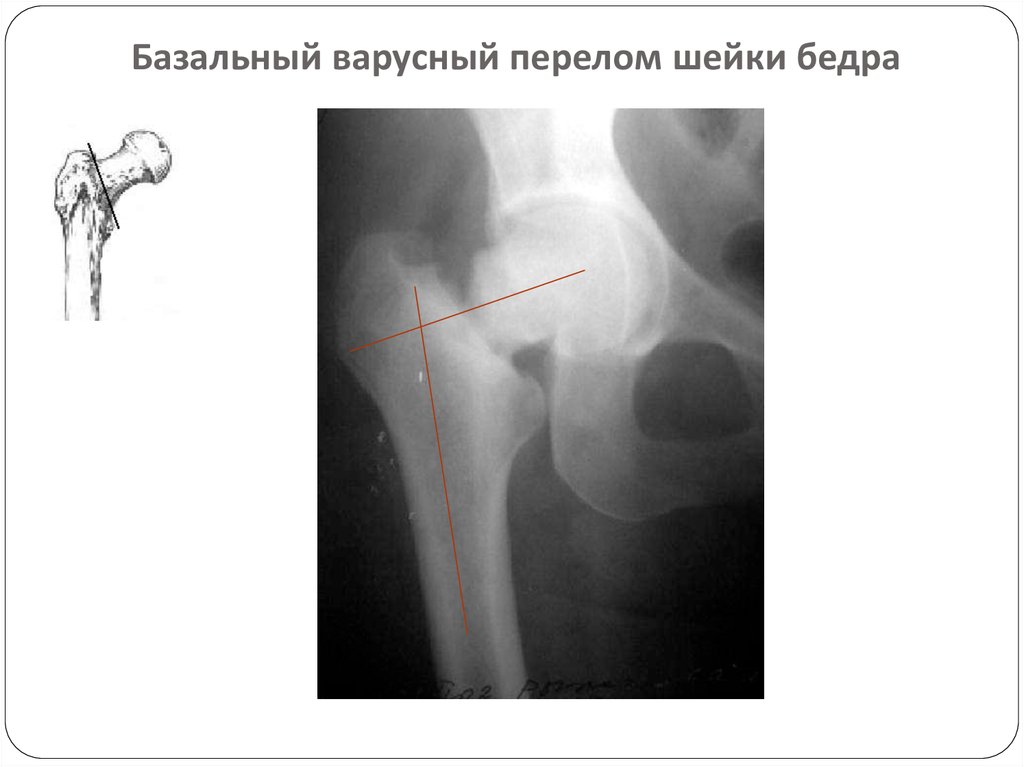 Шейка правого бедра. Перелом бедренной кости рентген. Вколоченный перелом шейки бедра рентген. Субкапитальный перелом шейки бедренной кости рентген. Закрытый аддукционный перелом шейки бедра.