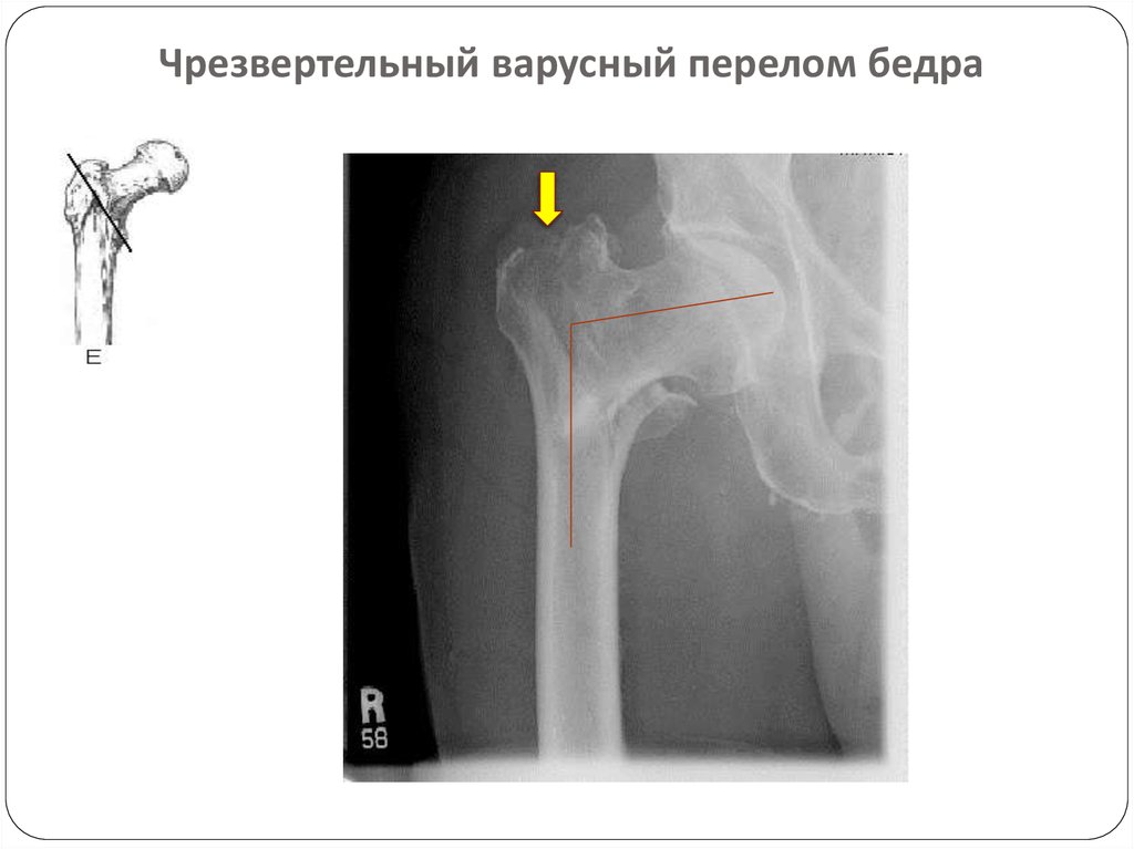 Чрезвертельный перелом шейки бедра