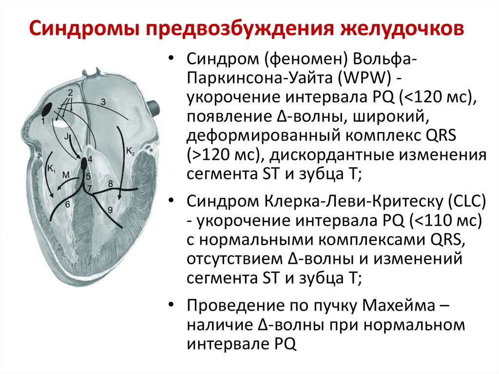 Нарушение процессов желудочков. Феномен предвозбуждения желудочков wpw. Феномен Вольфа-Паркинсона-Уайта на ЭКГ. Синдром предвозбуждения желудочков на ЭКГ. Синдром преждевременного возбуждения желудочков wpw.