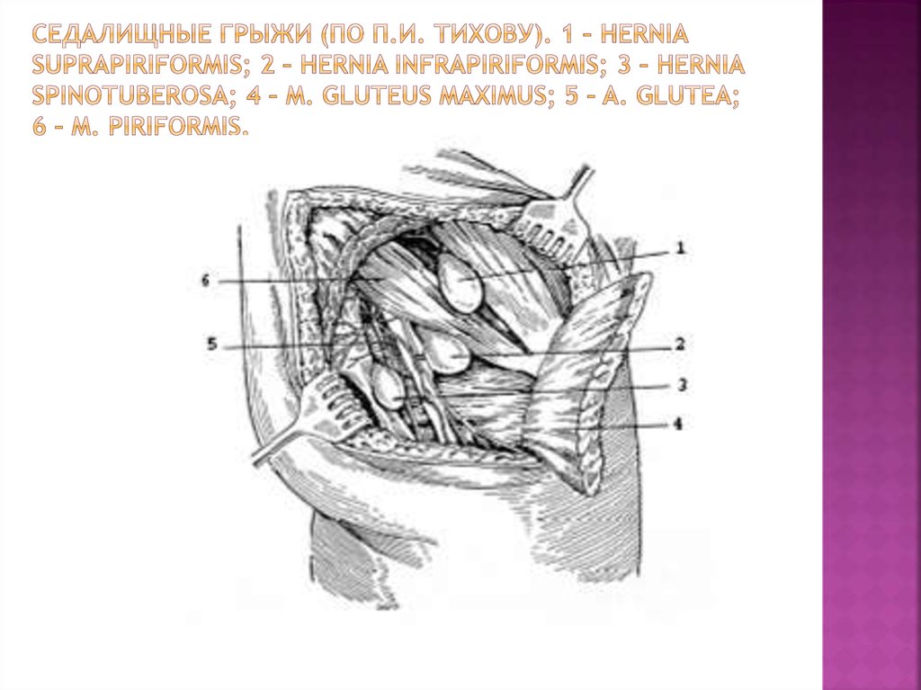 Защемление седалищного нерва межпозвоночной грыжей. Грыжа защемление седалищного нерва. Строение мышц таза седалищный нерв. Седалищная грыжа. Запирательный канал.