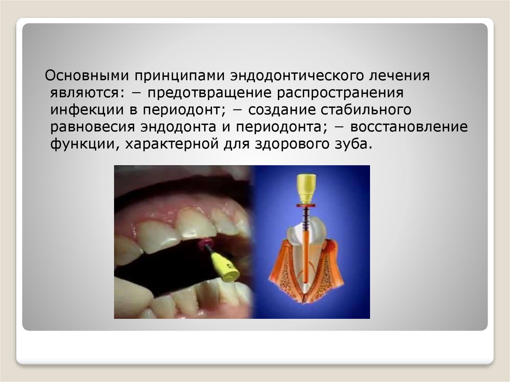 Повторное эндодонтическое лечение презентация