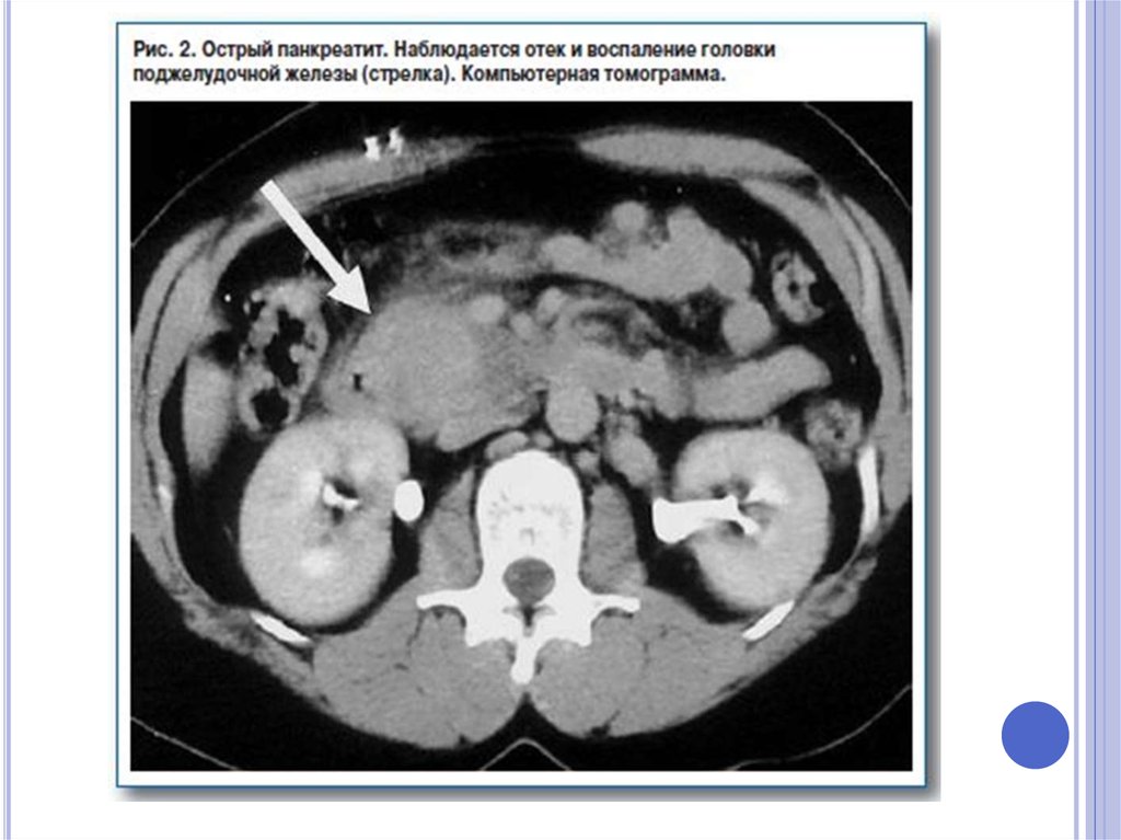 Кт картина панкреатита