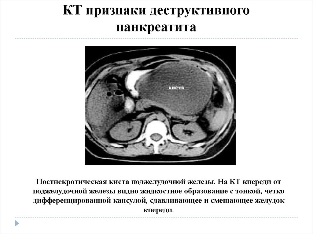 Кт признаки. Панкреонекроз поджелудочной железы кт. Некротизирующий панкреатит кт. Кт признаки хронического панкреатита. Хронический калькулезный панкреатит кт.