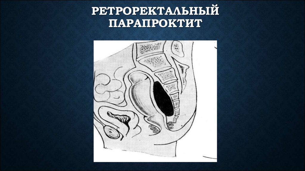 Парапроктит это. Ретроректальный парапроктит операция. Позадипрямокишечный парапроктит. Пельвиоректальный парапроктит. Ретроректальная клетчатка.