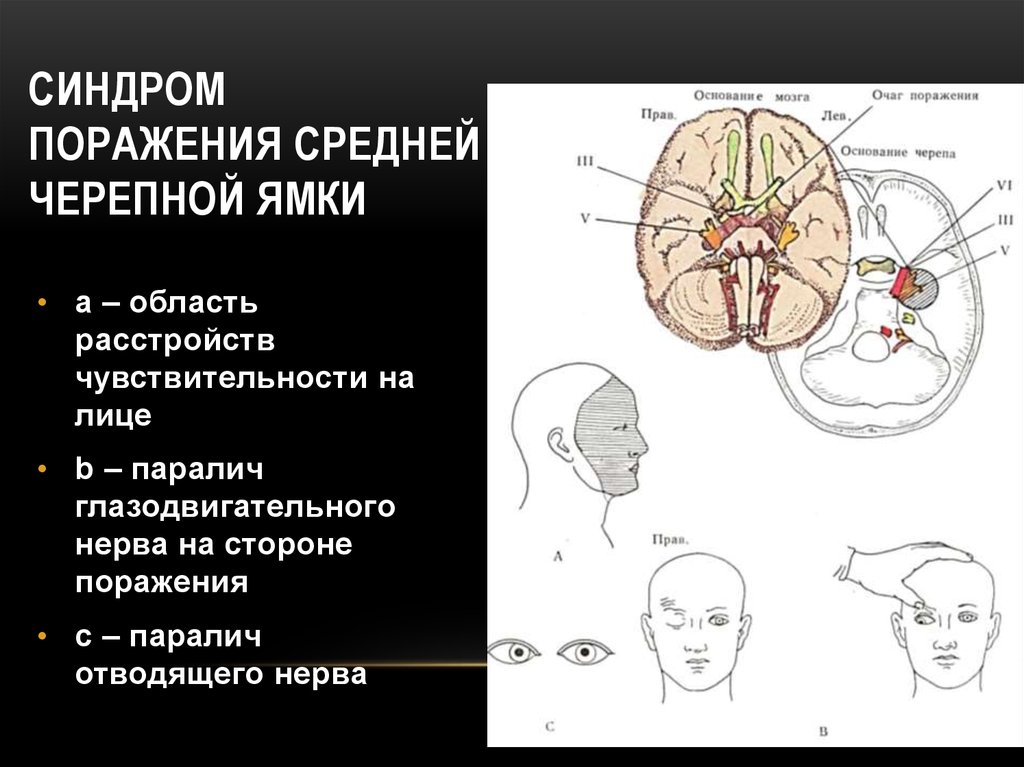 Головной мозг синдромы. Опухоли средней черепной ямки головного мозга. Синдром поражения основания головного мозга. Синдром поражения средней черепной ямки. Синдромы опухолей головного мозга.