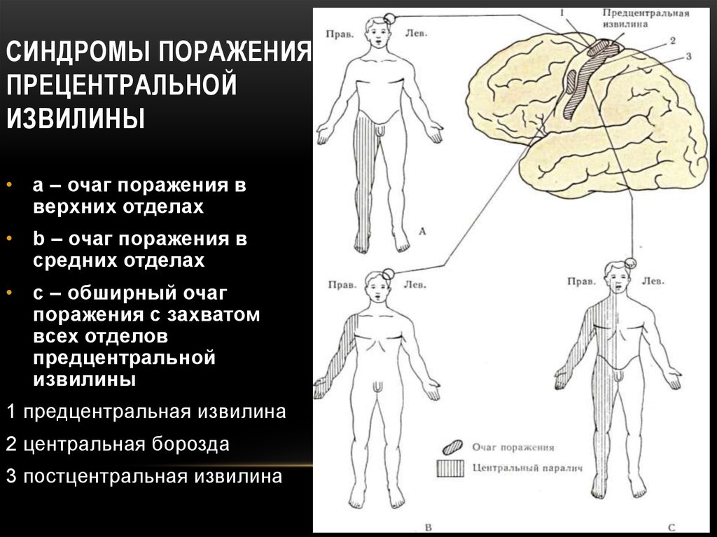 Синдром поражения