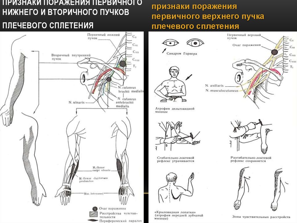 Нижний поражение. Поражение плечевого сплетения неврология. Синдром поражения нижних Корешков плечевого сплетения (с7 -д1). Поражение верхнего пучка плечевого сплетения. Методика выявления симптомов поражения плечевого сплетения.