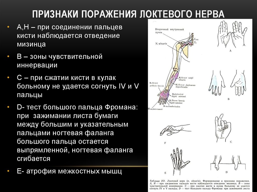 Метод поражения. Нейропатия локтевого нерва клиника. Невропатия локтевого нерва симптомы. Симптомы поражения локтевого нерва нерва. Клиника поражения локтевого нерва.