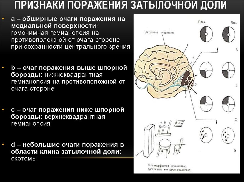 Расстройство полушарий. Поражение затылочной доли головного мозга симптомы. Симптомы поражения затылочной доли неврология. Повреждение затылочной доли головного мозга. Синдромы поражения отдельных лобных долей.