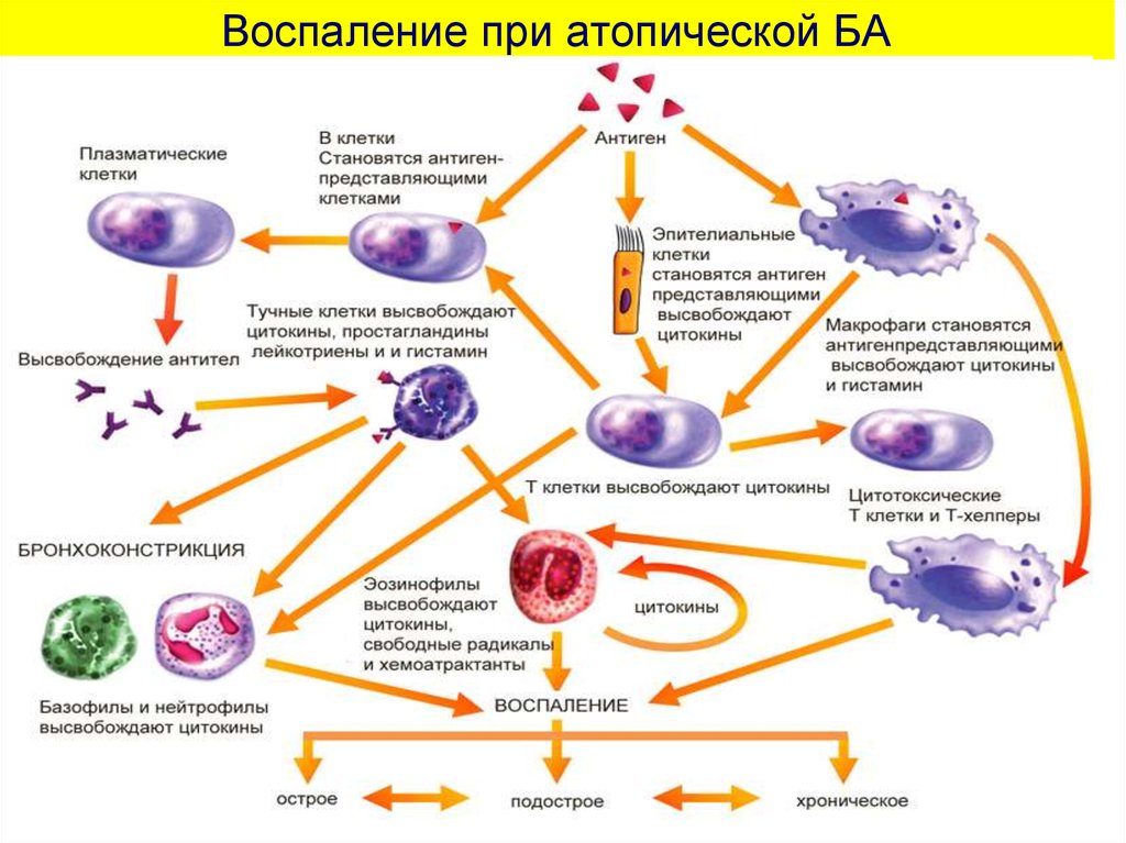 Клетки воспаления. Клеточные реакции при воспалении схема. Клетки, принимающие участие в развитии хронического воспаления:. Воспаление иммунология. Патогенез атопической бронхиальной астмы.