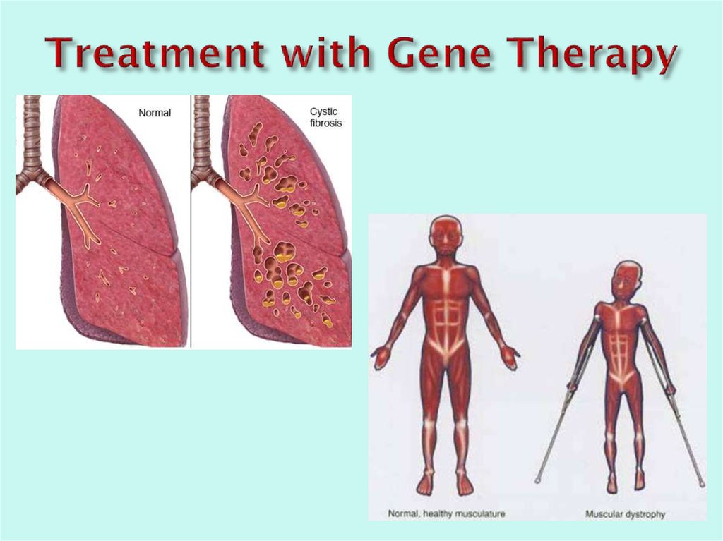 Treatment with Gene Therapy