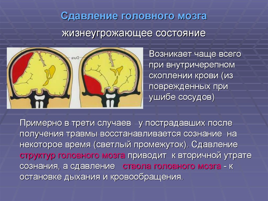 Повреждения головного мозга возникают. Сдавление головного мозга. Сдавление головного мозга внутричерепными гематомами. Сдавление ствола мозга. Сдавливание головного мозга клиника.