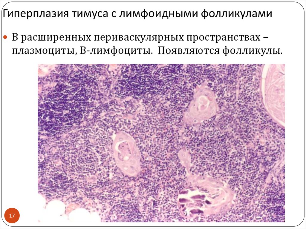Реактивная гиперплазия лимфоузла. Акцидентальная инволюция тимуса микропрепарат. Гиперплазия лимфоидной фолликулов. Гиперплазия тимуса с лимфоидными фолликулами. Акцидентальная инволюция тимуса гистология.