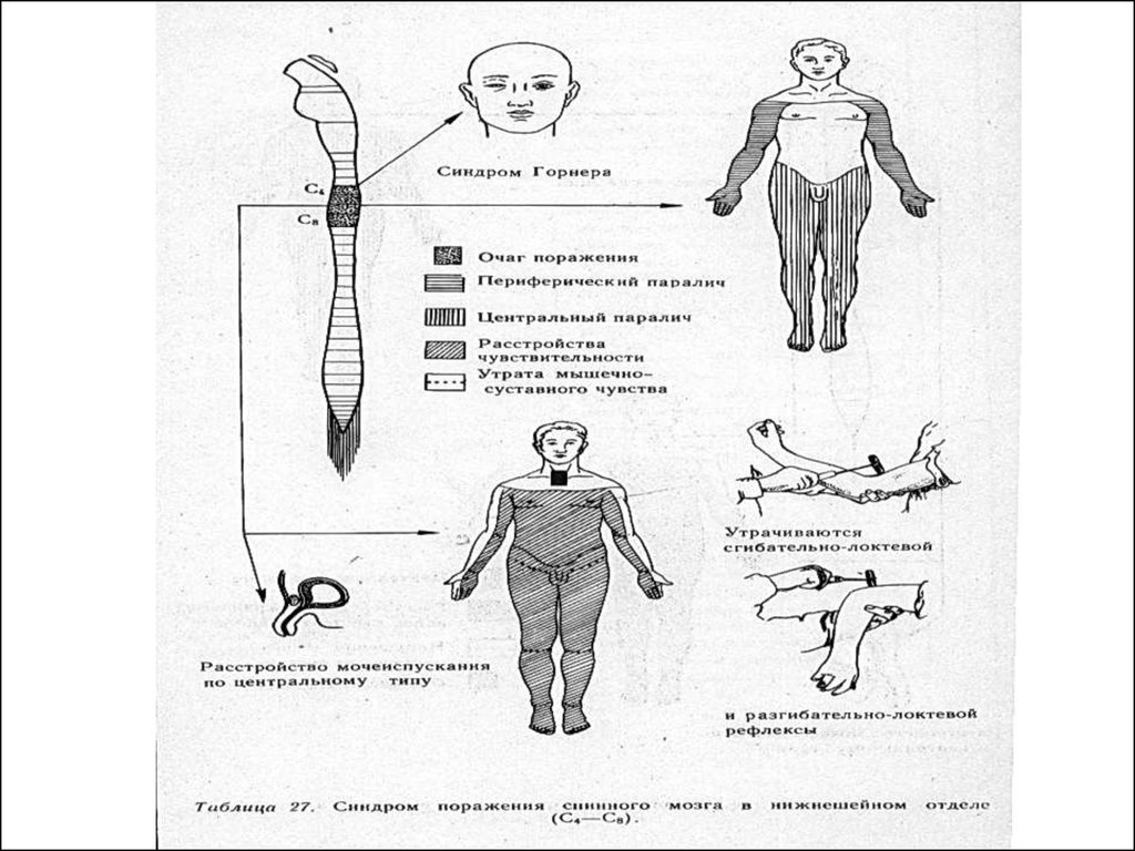 Клиническая картина периферического паралича