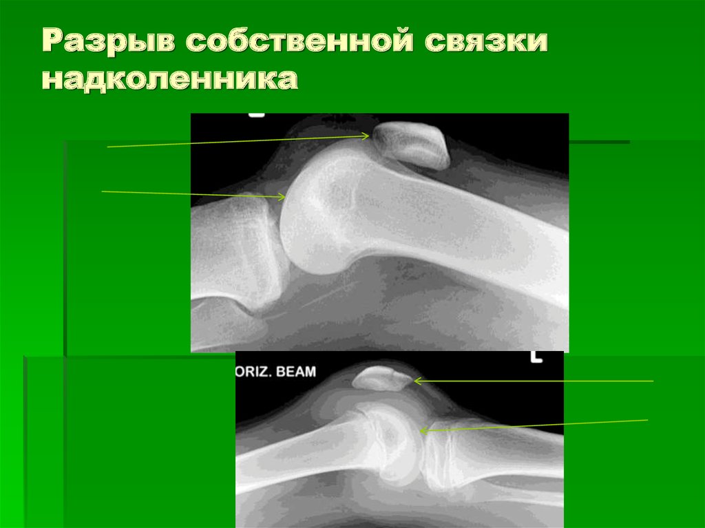 Собственная связка. Повреждение связок надколенника рентген. Оссификация сухожилия надколенника. Повреждение сухожилие надколенника. Отрыв связки надколенника.