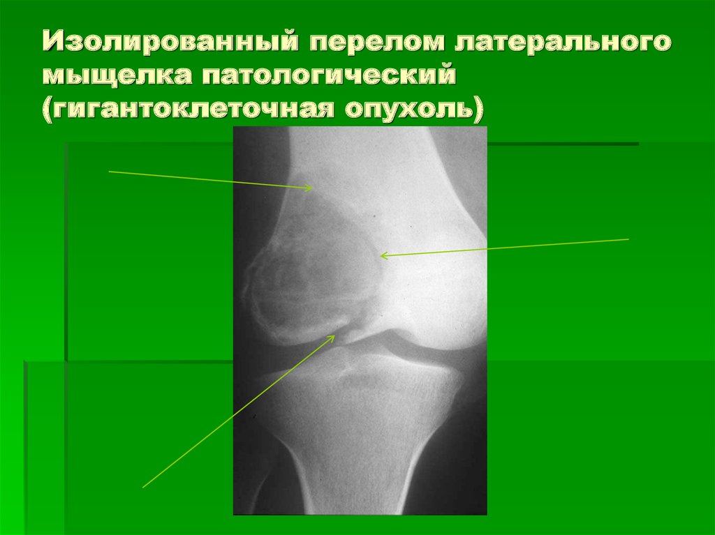 Изолированный перелом латерального мыщелка патологический (гигантоклеточная опухоль)
