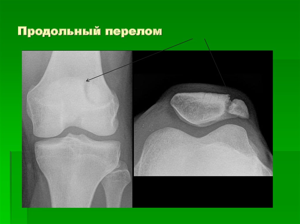 Перелом надколенника сроки. Продольный перелом надколенника. Перелом надколенника рентген. Краевой перелом надколенника рентген. Переломы надколенника классификация.