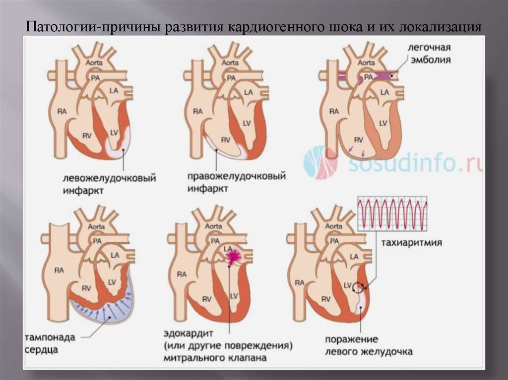 Кардиогенный шок наиболее часто. Причины развития кардиогенного шока. Патологии причины развития кардиогенного шока. Рефлекторный кардиогенный ШОК. Кардиогенный ШОК сердце.