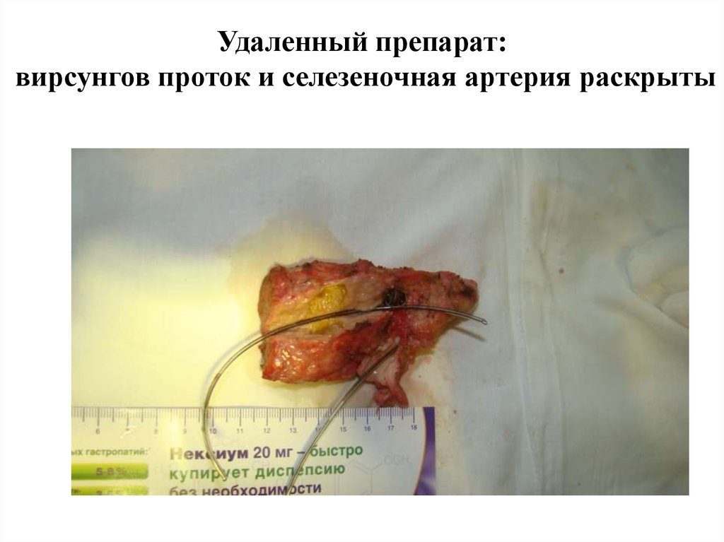 Удаленный препарат: вирсунгов проток и селезеночная артерия раскрыты