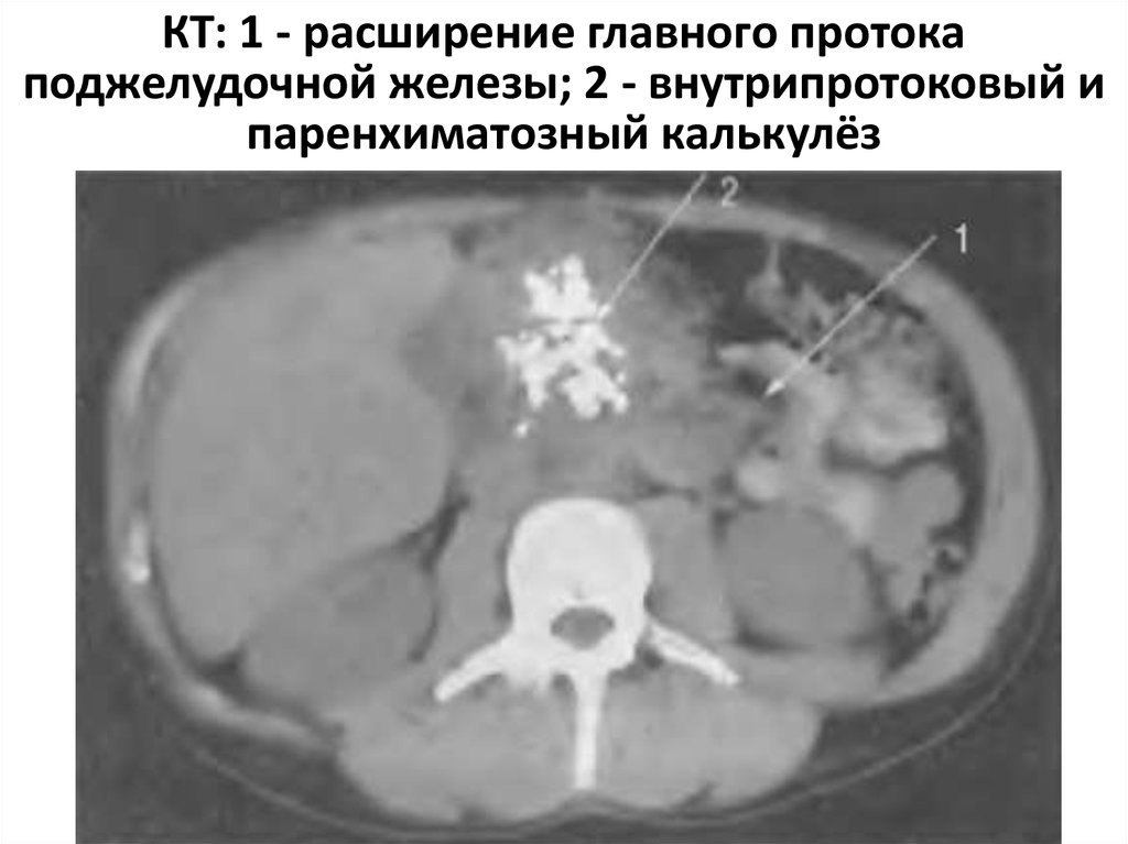 Расширение протоков