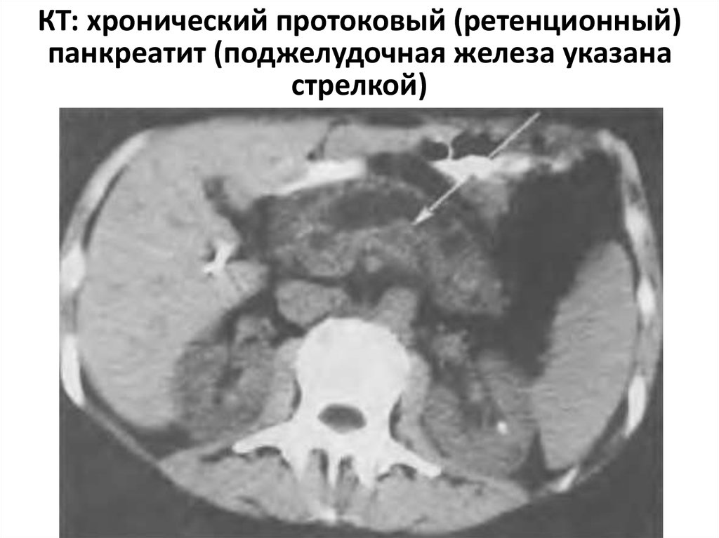 Кт картина панкреатита