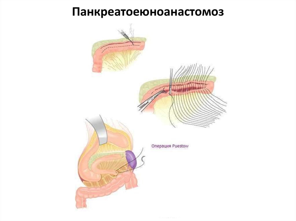 Панкреатоеюноанастомоз